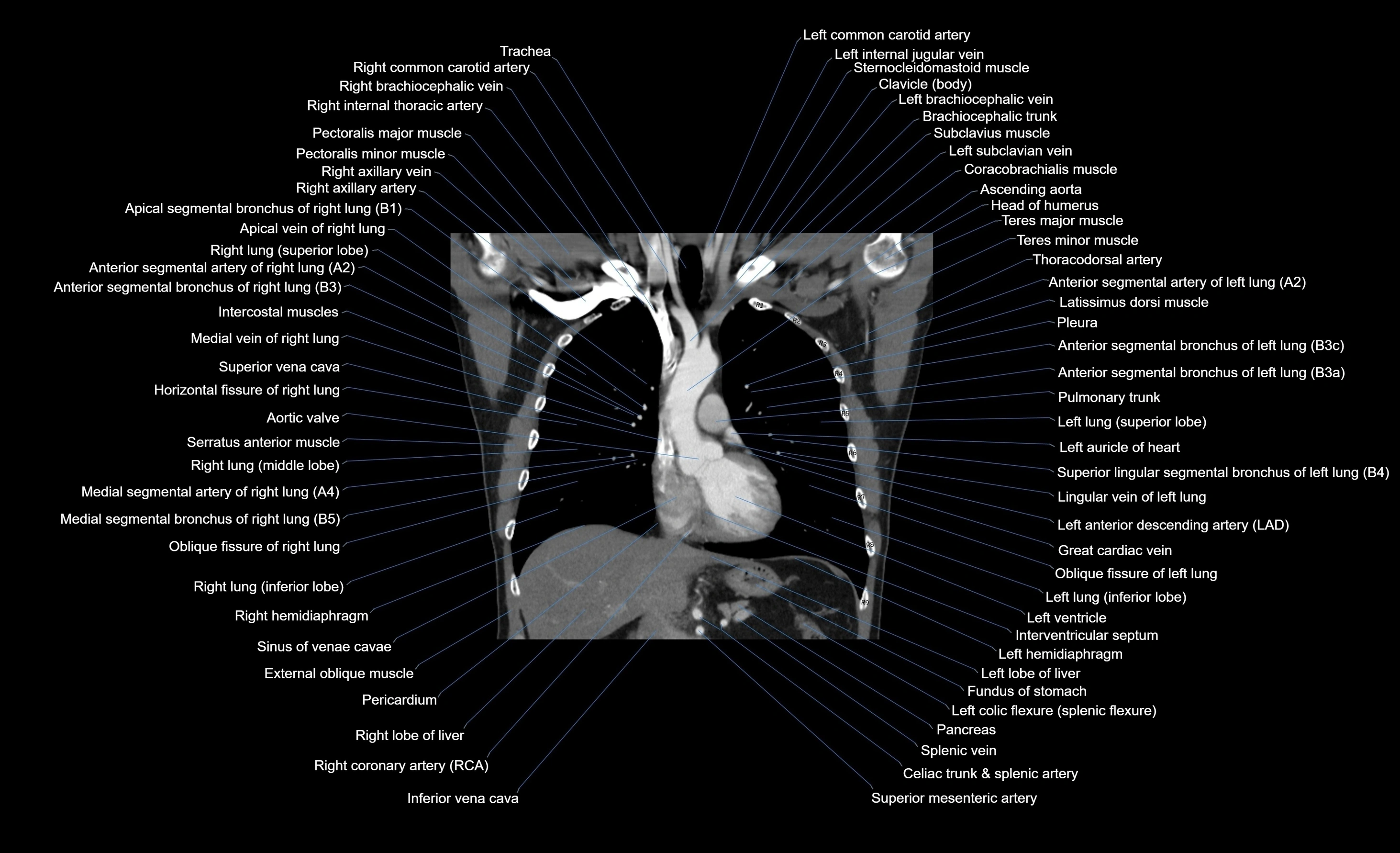 CT chest (thorax) soft tissue window labelled coronal cross sectional anatomy radiology image-00069.webp